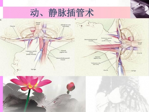 插管第2460期动态图，插管技术的新里程碑-第1张图片