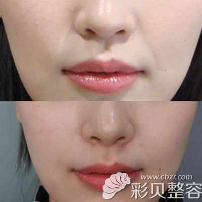 徐海星整容前后徐海星整容前后对比
